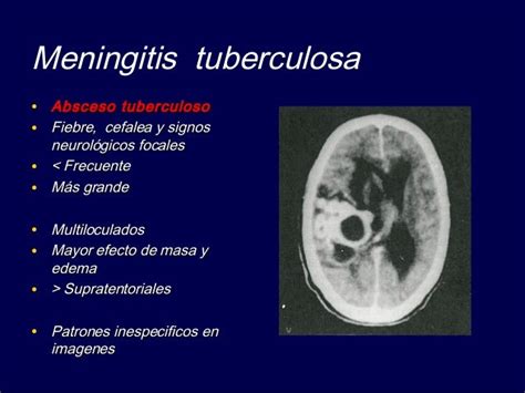 meningite tuberculosa msd